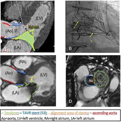 TMVR after TA-TAVR: a re-redo surgery—case report